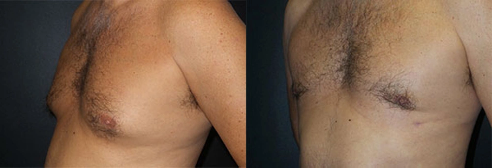 Real Patient Results in Newport Beach, CA. Preformed by Semira Bayait, MD, FACS.