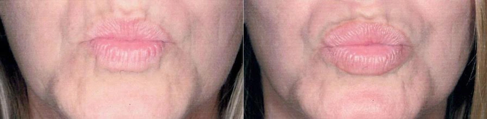 Real Patient Results in Newport Beach, CA. Preformed by Semira Bayait, MD, FACS.