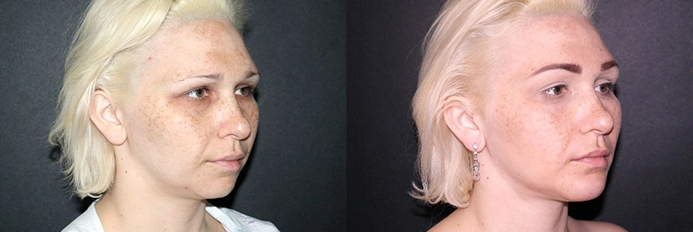 Real Patient Results in Newport Beach, CA. Preformed by Semira Bayait, MD, FACS.