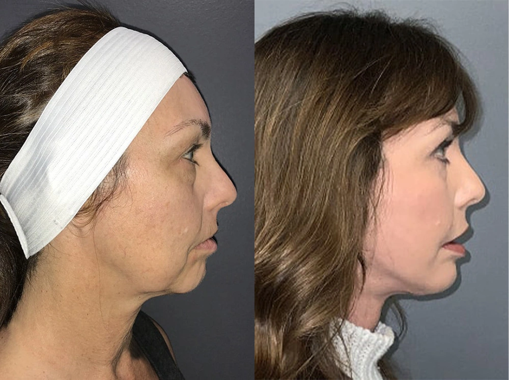 Real Patient Results in Newport Beach, CA. Preformed by Semira Bayait, MD, FACS.