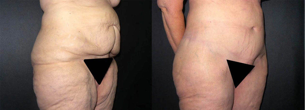 Real Patient Results in Newport Beach, CA. Preformed by Semira Bayait, MD, FACS.