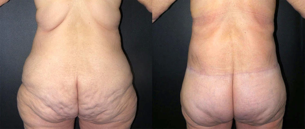 Real Patient Results in Newport Beach, CA. Preformed by Semira Bayait, MD, FACS.