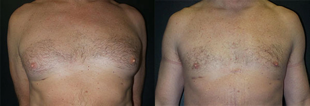 Real Patient Results in Newport Beach, CA. Preformed by Semira Bayait, MD, FACS.