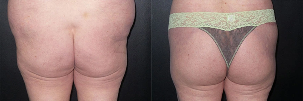 Real Patient Results in Newport Beach, CA. Preformed by Semira Bayait, MD, FACS.