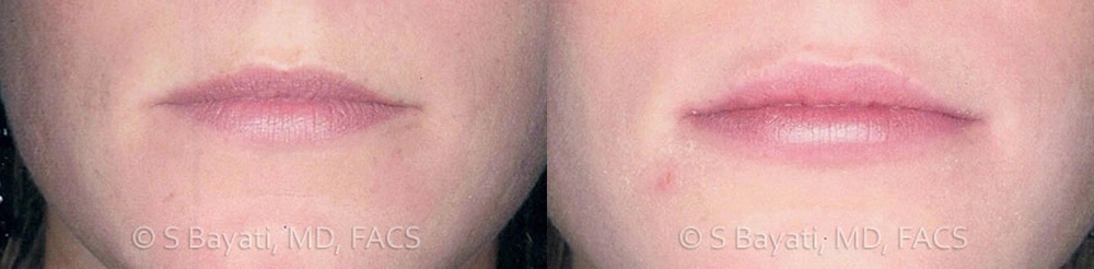Real Patient Results in Newport Beach, CA. Preformed by Semira Bayait, MD, FACS.