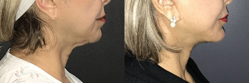 Real Patient Results in Newport Beach, CA. Preformed by Semira Bayait, MD, FACS.