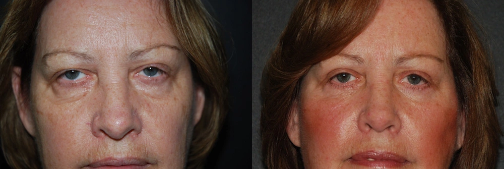 Real Patient Results in Newport Beach, CA. Preformed by Semira Bayait, MD, FACS.