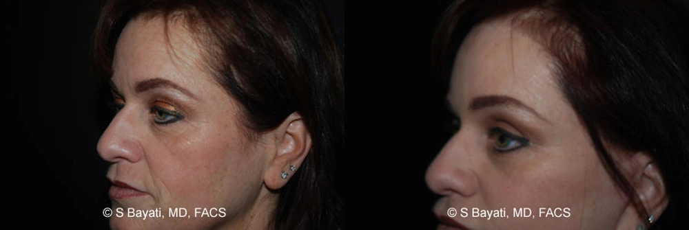 Real Patient Results in Newport Beach, CA. Preformed by Semira Bayait, MD, FACS.