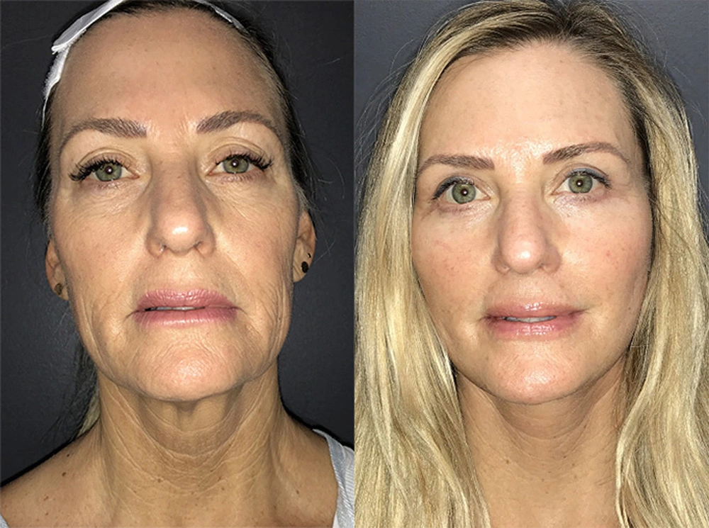 Real Patient Results in Newport Beach, CA. Preformed by Semira Bayait, MD, FACS.