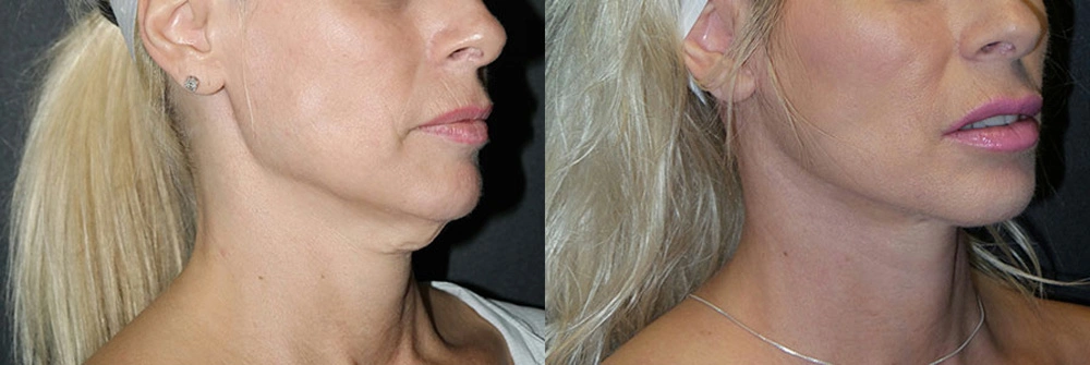 Real Patient Results in Newport Beach, CA. Preformed by Semira Bayait, MD, FACS.