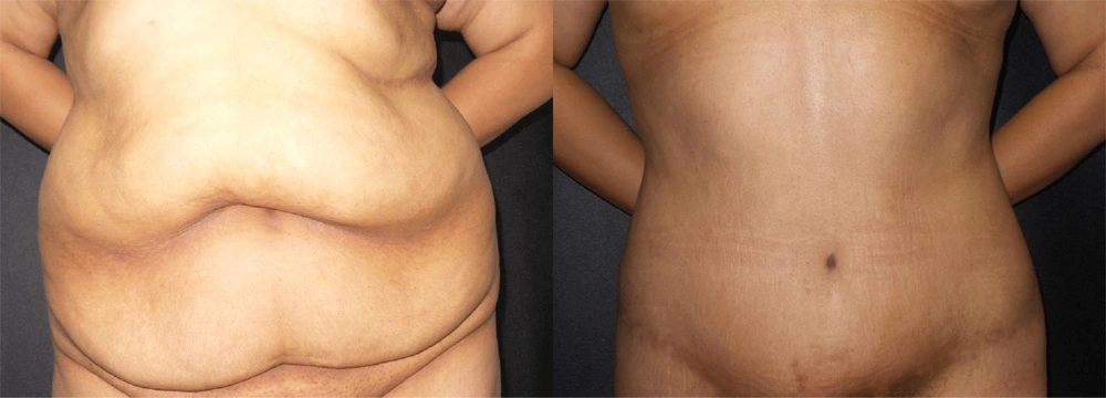 Real Patient Results in Newport Beach, CA. Preformed by Semira Bayait, MD, FACS.