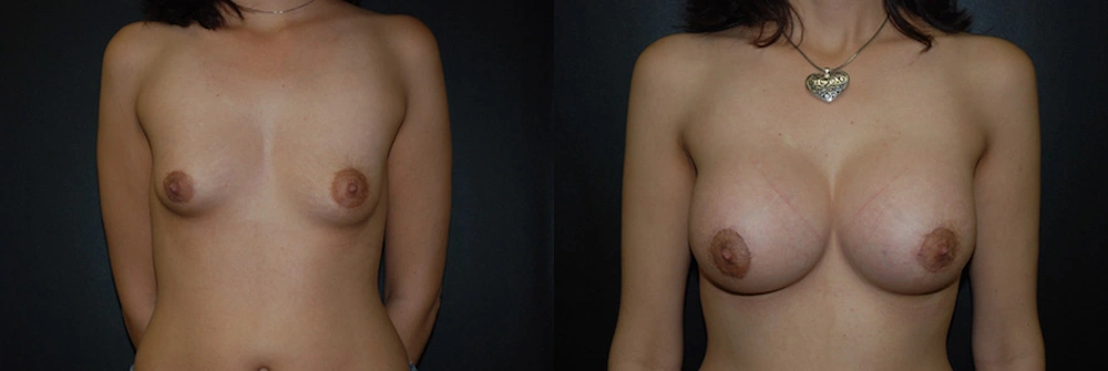 Real Patient Results in Newport Beach, CA. Preformed by Semira Bayait, MD, FACS.