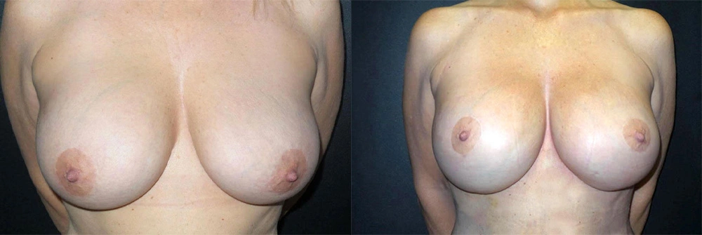 Real Patient Results in Newport Beach, CA. Preformed by Semira Bayait, MD, FACS.