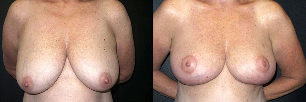 Real Patient Results in Newport Beach, CA. Preformed by Semira Bayait, MD, FACS.