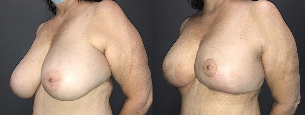 Real Patient Results in Newport Beach, CA. Preformed by Semira Bayait, MD, FACS.