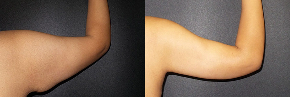 Real Patient Results in Newport Beach, CA. Preformed by Semira Bayait, MD, FACS.