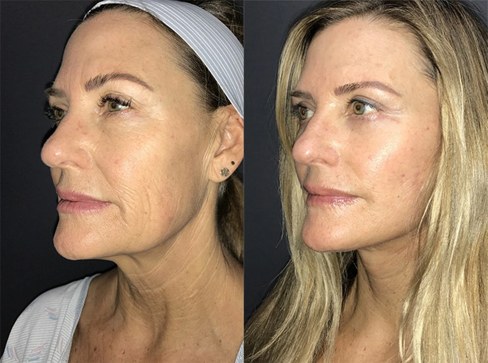 Real Patient Results in Newport Beach, CA. Preformed by Semira Bayait, MD, FACS.