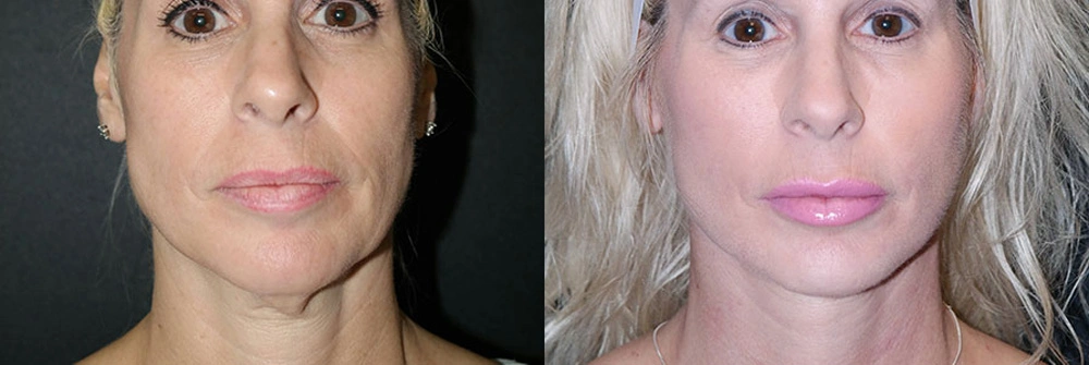 Real Patient Results in Newport Beach, CA. Preformed by Semira Bayait, MD, FACS.