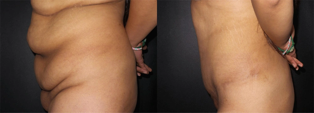 Real Patient Results in Newport Beach, CA. Preformed by Semira Bayait, MD, FACS.