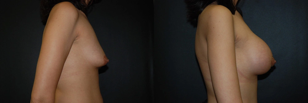 Real Patient Results in Newport Beach, CA. Preformed by Semira Bayait, MD, FACS.