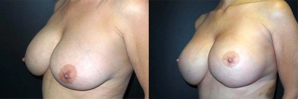 Real Patient Results in Newport Beach, CA. Preformed by Semira Bayait, MD, FACS.