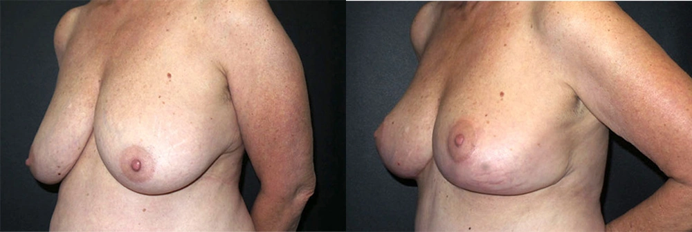 Real Patient Results in Newport Beach, CA. Preformed by Semira Bayait, MD, FACS.