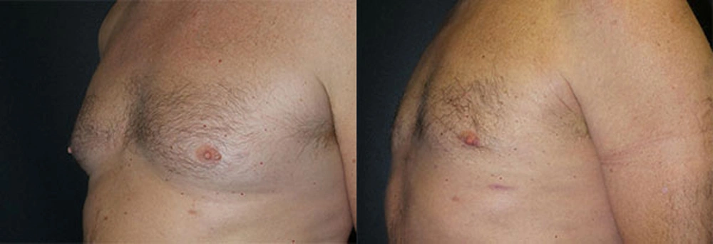 Real Patient Results in Newport Beach, CA. Preformed by Semira Bayait, MD, FACS.