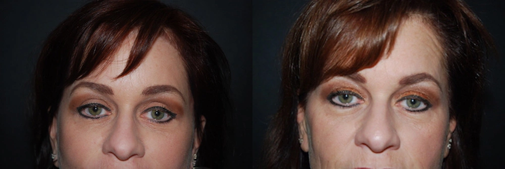 Real Patient Results in Newport Beach, CA. Preformed by Semira Bayait, MD, FACS.