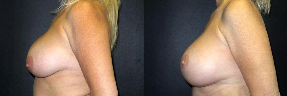 Real Patient Results in Newport Beach, CA. Preformed by Semira Bayait, MD, FACS.