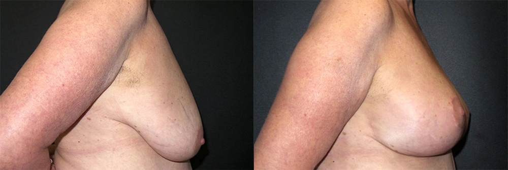 Real Patient Results in Newport Beach, CA. Preformed by Semira Bayait, MD, FACS.