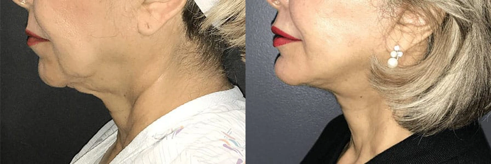 Real Patient Results in Newport Beach, CA. Preformed by Semira Bayait, MD, FACS.