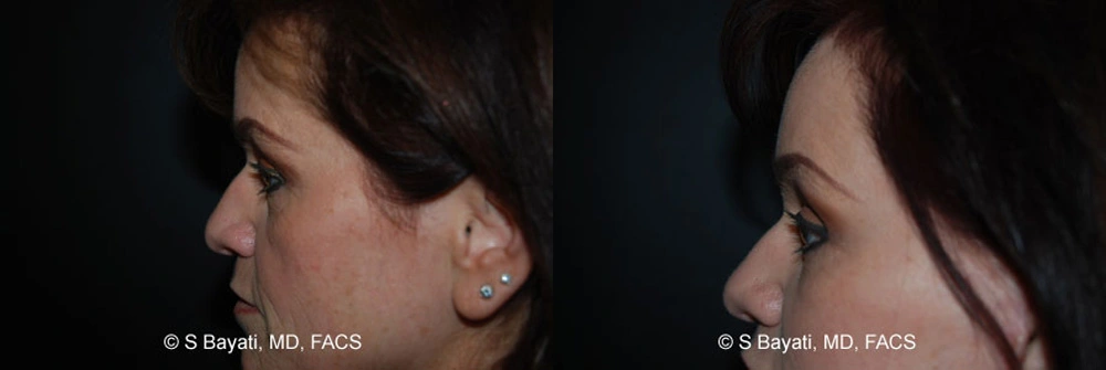 Real Patient Results in Newport Beach, CA. Preformed by Semira Bayait, MD, FACS.
