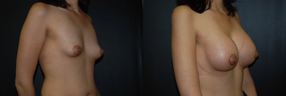 Real Patient Results in Newport Beach, CA. Preformed by Semira Bayait, MD, FACS.