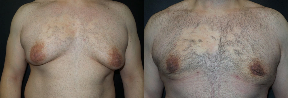 Real Patient Results in Newport Beach, CA. Preformed by Semira Bayait, MD, FACS.