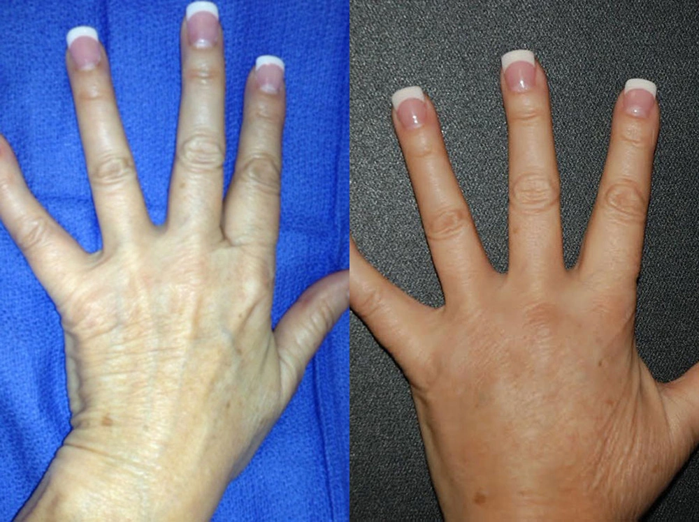 Real Patient Results in Newport Beach, CA. Preformed by Semira Bayait, MD, FACS.
