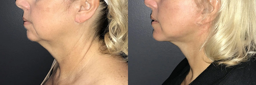 Real Patient Results in Newport Beach, CA. Preformed by Semira Bayait, MD, FACS.