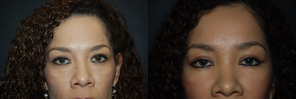 Real Patient Results in Newport Beach, CA. Preformed by Semira Bayait, MD, FACS.