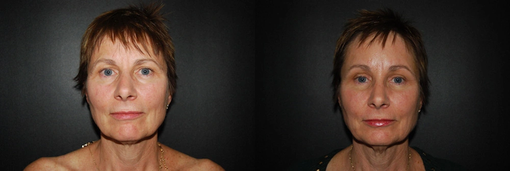Real Patient Results in Newport Beach, CA. Preformed by Semira Bayait, MD, FACS.
