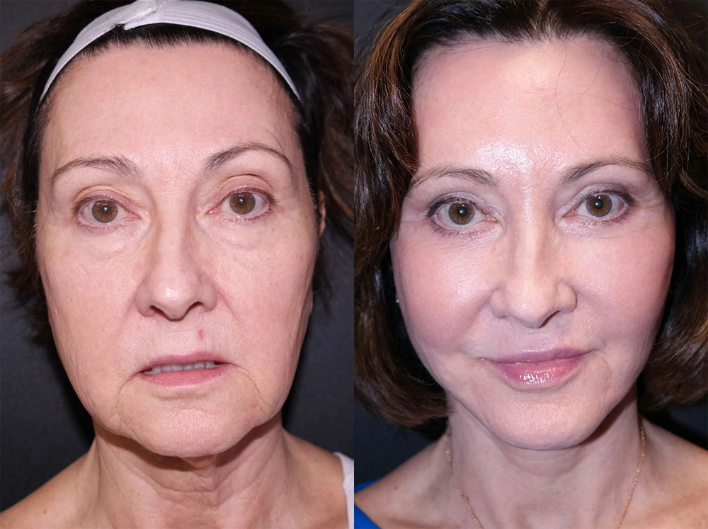 Real Patient Results in Newport Beach, CA. Preformed by Semira Bayait, MD, FACS.