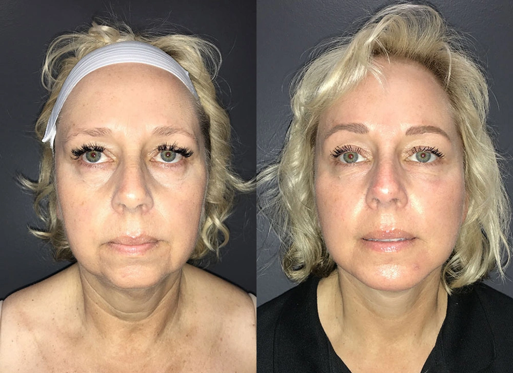 Real Patient Results in Newport Beach, CA. Preformed by Semira Bayait, MD, FACS.