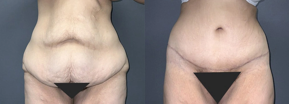 Real Patient Results in Newport Beach, CA. Preformed by Semira Bayait, MD, FACS.