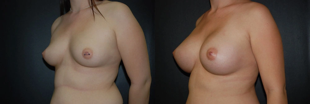 Real Patient Results in Newport Beach, CA. Preformed by Semira Bayait, MD, FACS.