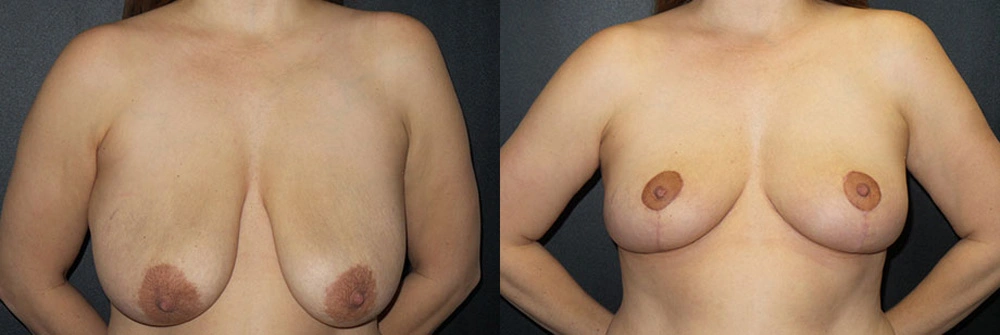 Real Patient Results in Newport Beach, CA. Preformed by Semira Bayait, MD, FACS.