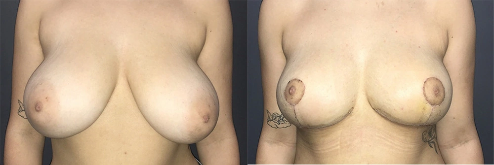 Real Patient Results in Newport Beach, CA. Preformed by Semira Bayait, MD, FACS.