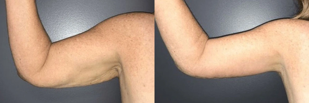 Real Patient Results in Newport Beach, CA. Preformed by Semira Bayait, MD, FACS.
