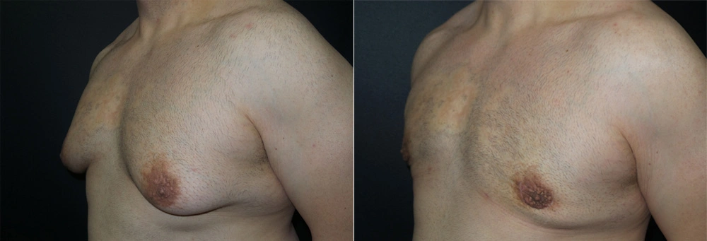 Real Patient Results in Newport Beach, CA. Preformed by Semira Bayait, MD, FACS.