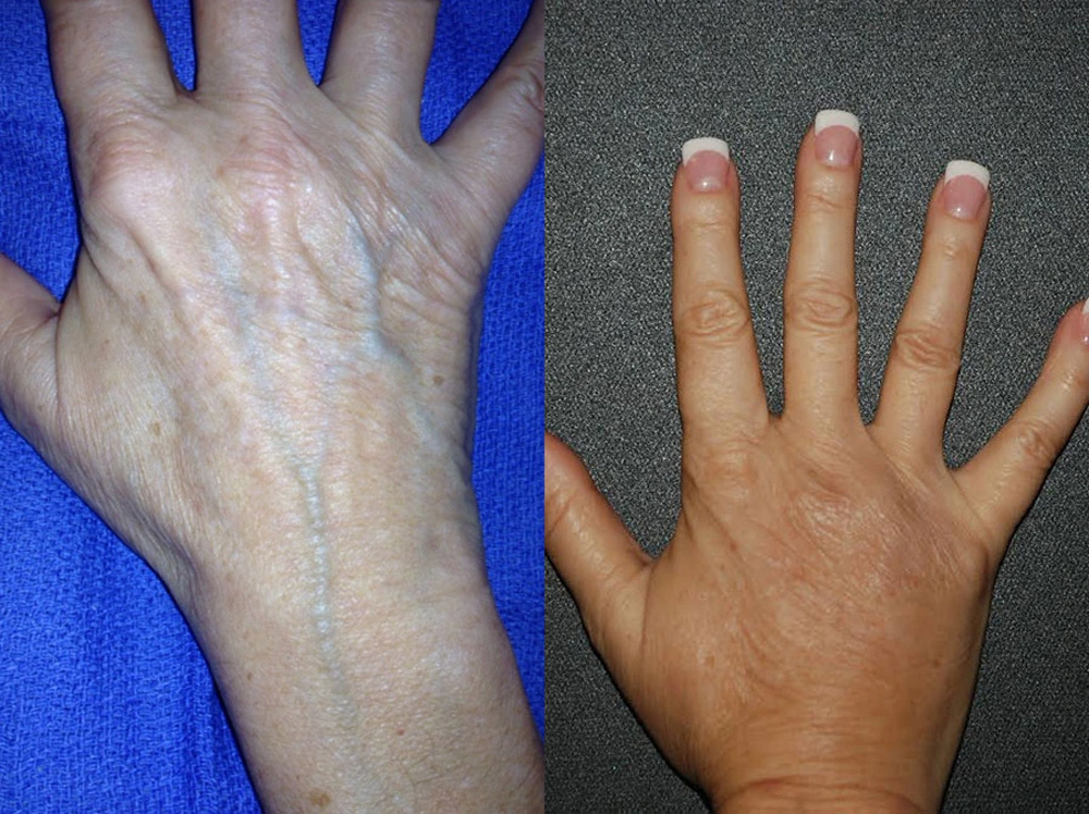 Real Patient Results in Newport Beach, CA. Preformed by Semira Bayait, MD, FACS.