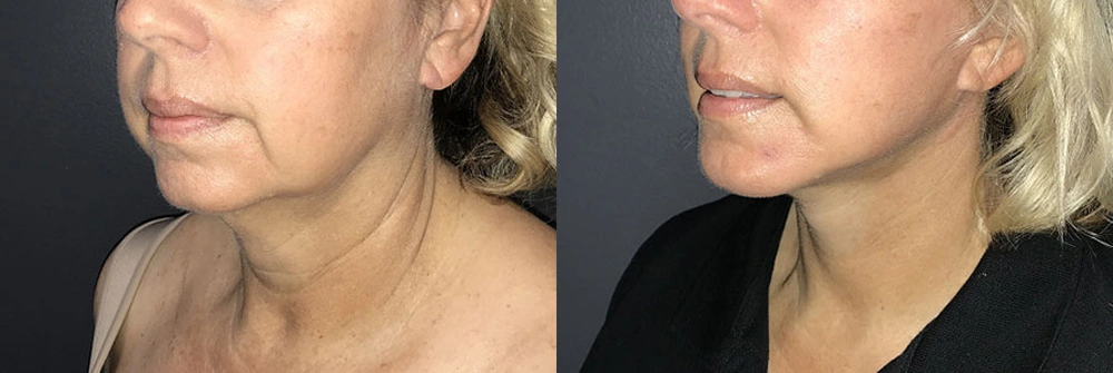 Real Patient Results in Newport Beach, CA. Preformed by Semira Bayait, MD, FACS.