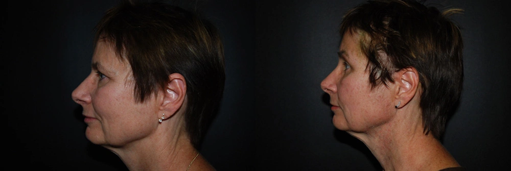 Real Patient Results in Newport Beach, CA. Preformed by Semira Bayait, MD, FACS.
