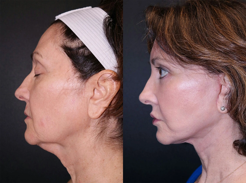 Real Patient Results in Newport Beach, CA. Preformed by Semira Bayait, MD, FACS.